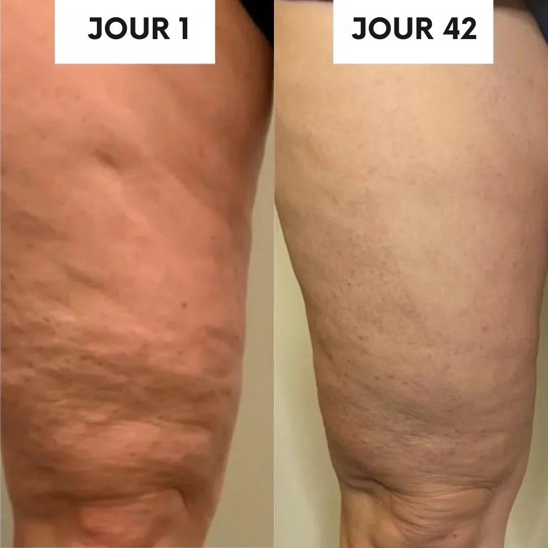 Ventouse anti-cellulite
